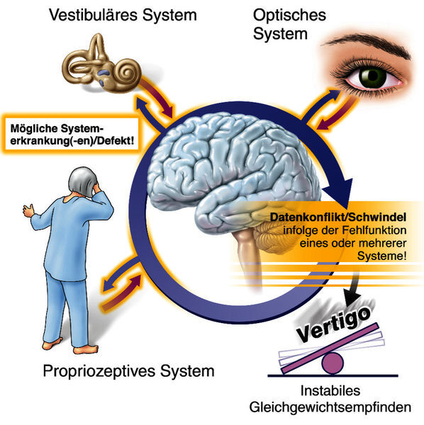 Eine Grafik illustriert die Entstehung von Schwindel und instabilem Gleichgewichtsempfinden. Widersprüchliche Sinneseindrücke werden an das Gehirn gesendet und sorgen für einen Datenkonflikt. Vertigo entsteht. Die Informationen werden vom Optischen System, dem Propriozeptivem System und dem Vestibulären System ausgesandt.