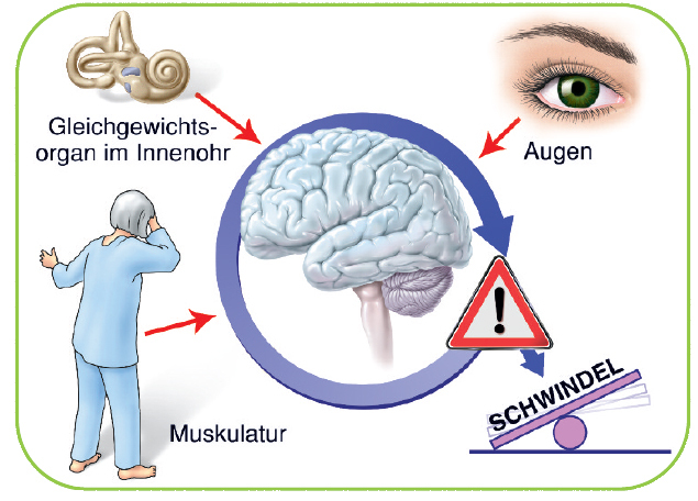 Eine Grafik erklärt die mögliche Entstehung einer Gleichgewichtsstörung mit gezeichneten Bildern. Widersprüchliche Sinneseindrücke der Muskulatur, der Augen und des Gleichgewichtsorgans im Innenohr erreichen das Gehirn und Schwindel entsteht.